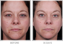 Load image into Gallery viewer, Obagi Blue Peel RADIANCE
